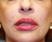 Feel Beautiful - Filler in creases around lips - After Photo
